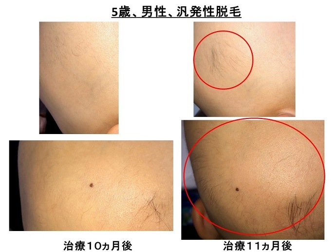 汎発性脱毛　病院
